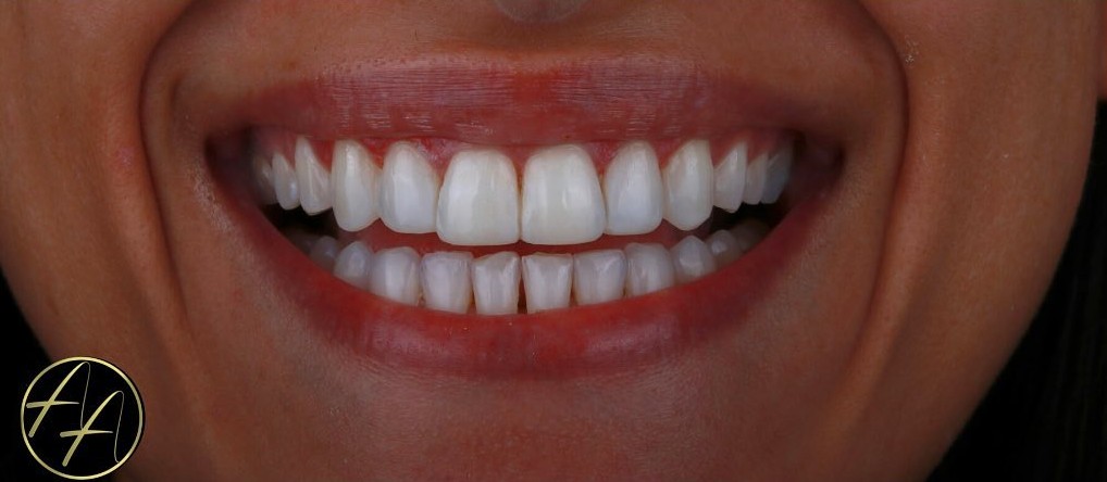 Case 01 After